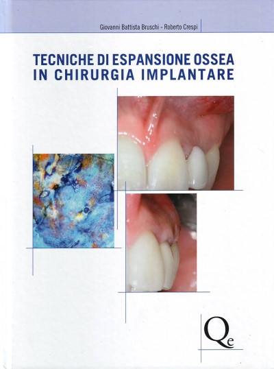 Tecniche di espansione ossea in chirurgia implantare